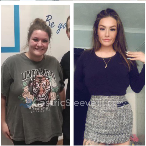 Weight Loss Surgery: Elipse Balloon Esme Review