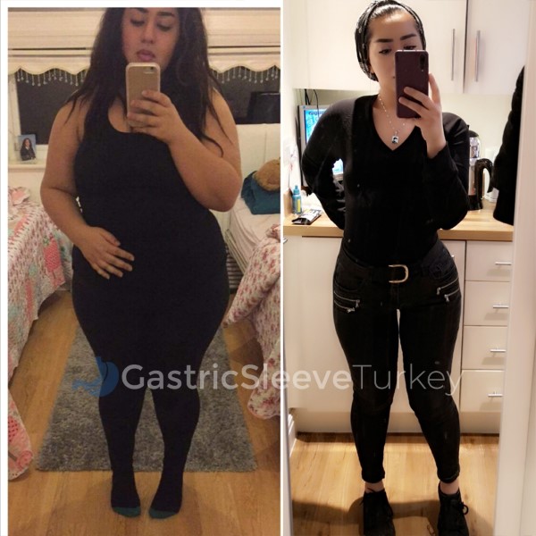 Weight Loss Surgery: Gastric Balloon Evelyn Review