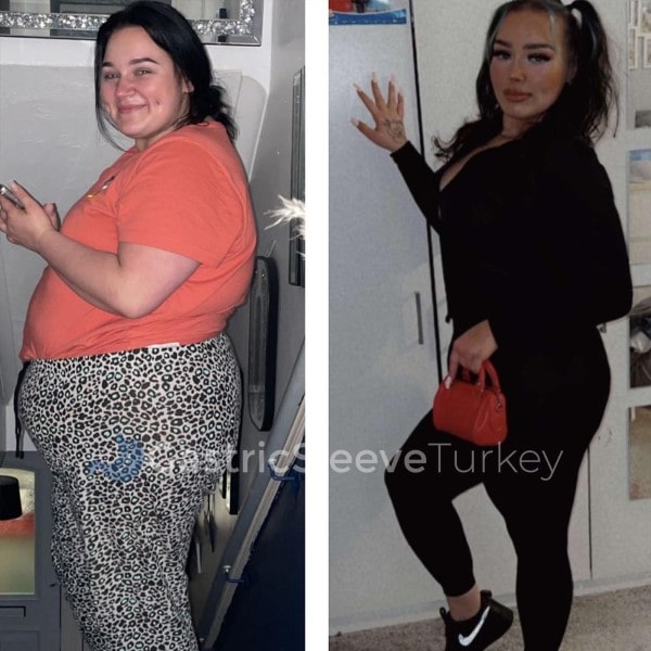 Weight Loss Surgery: Gastric Bypass Aurora Review