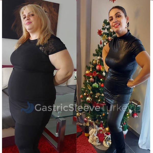 Weight Loss Surgery: Gastric Bypass Ellie Review