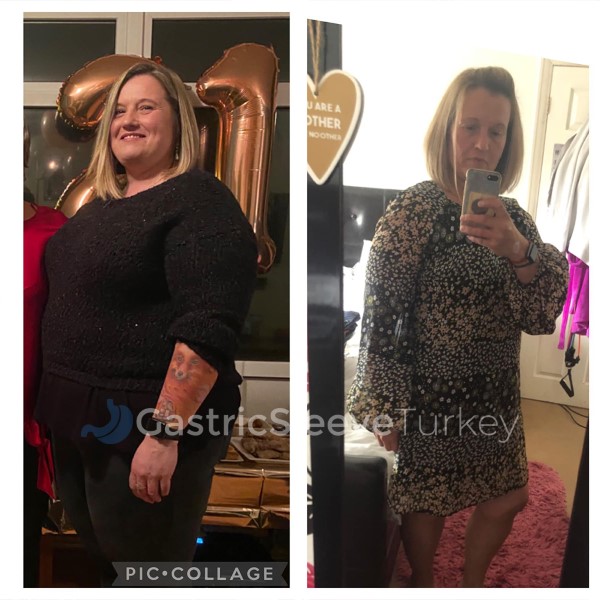 Weight Loss Surgery: Gastric Bypass Violet Review