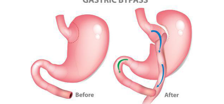 10 Reasons to Have Gastric Bypass