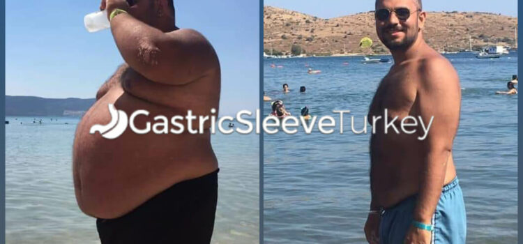 Gastric Sleeve Before and After Skin