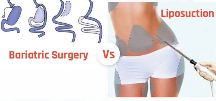 Gastric Bypass Surgery vs Liposuction