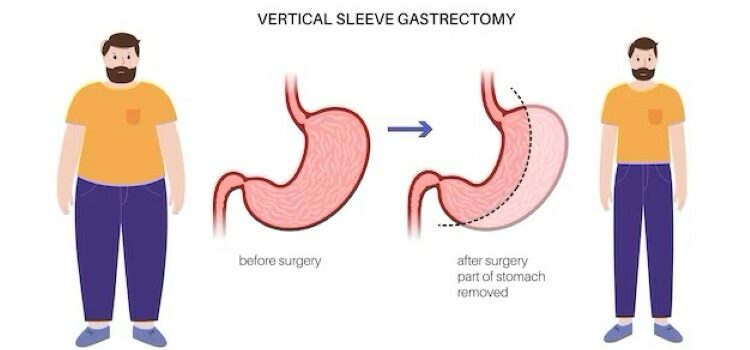 Sleeve Gastrectomy Scars