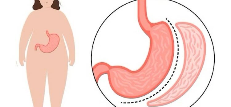 What is a Sleeve Gastrectomy?