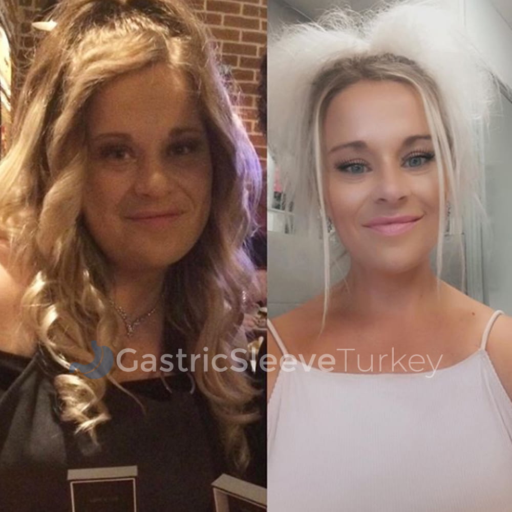 becky-10-months-after-gastric-sleeve