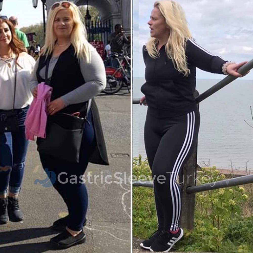 becky-5-months-after-gastric-sleeve