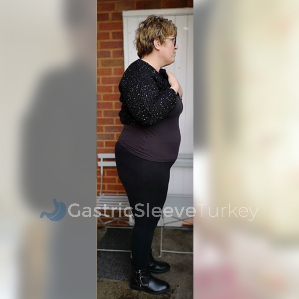 jo-before-gastric-sleeve