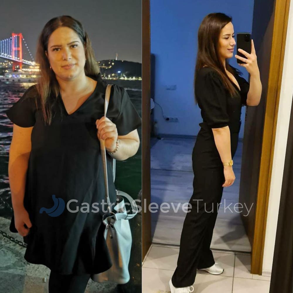 sumeyye-after-12-months-gastric-sleeve