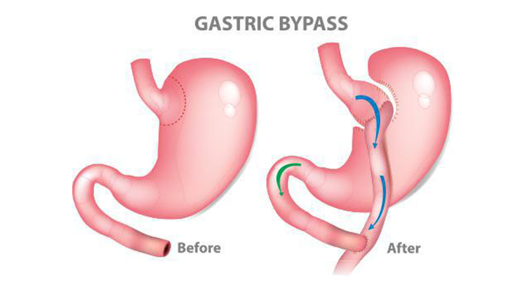 Reasons to Have Gastric Bypass