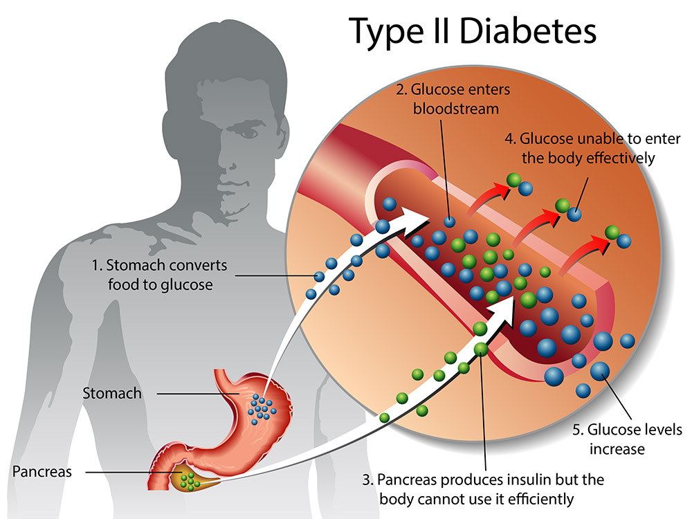 bariatric surgery for type 2 diabetes