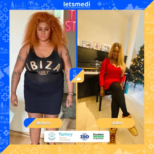 gastric sleeve before and after skin