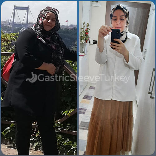 Bariatric surgery in turkey reviews